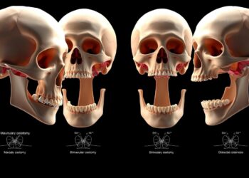Orthognathic Surgery Options: 4 Procedures to Correct Jaw Misalignment (2025 Patient Guide) 10 types of orthognathic surgery